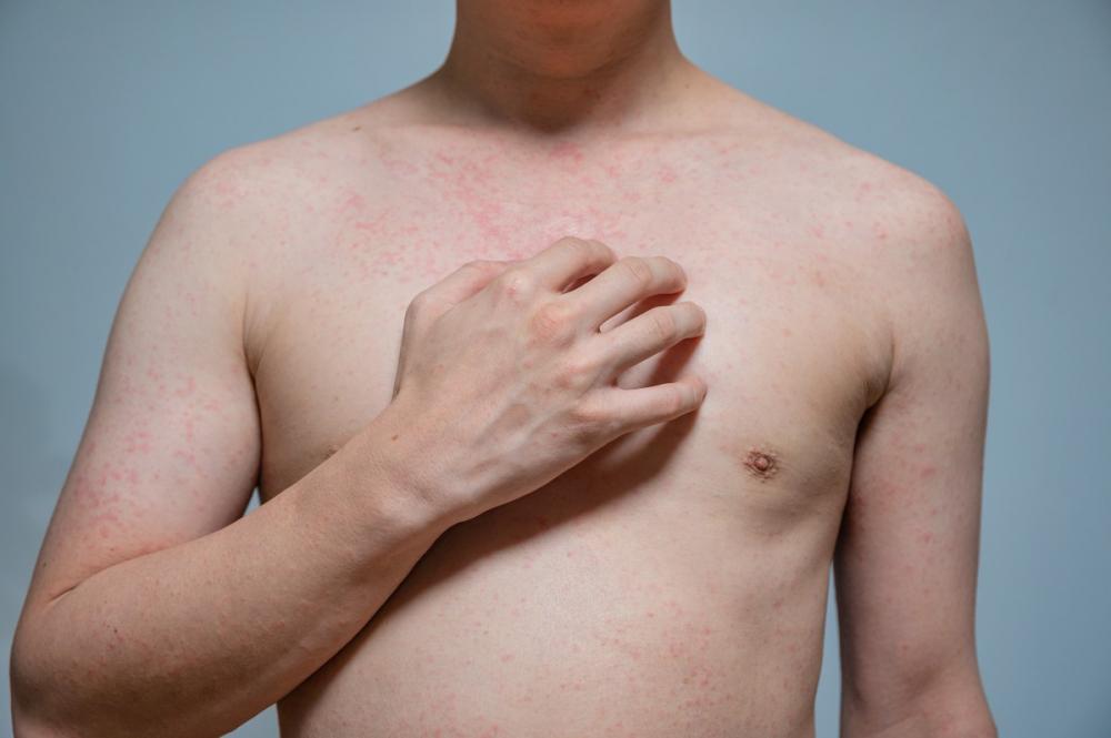 Сыпь на груди у мужчины