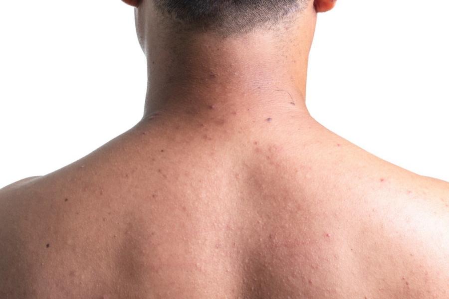 Прыщи на шее: причины и лечение