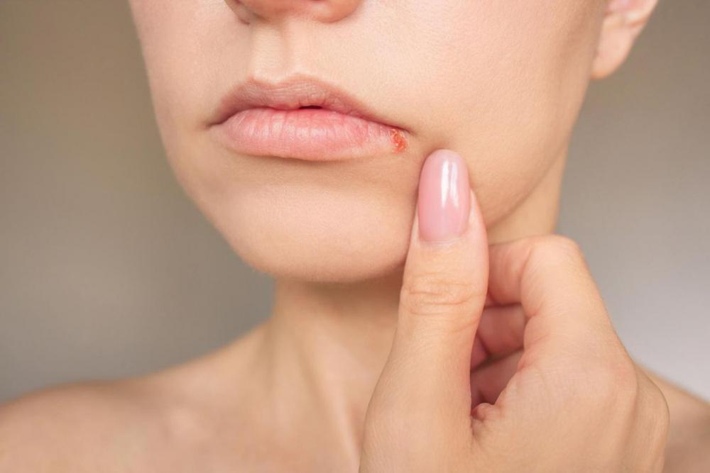 Болячки в уголках губ