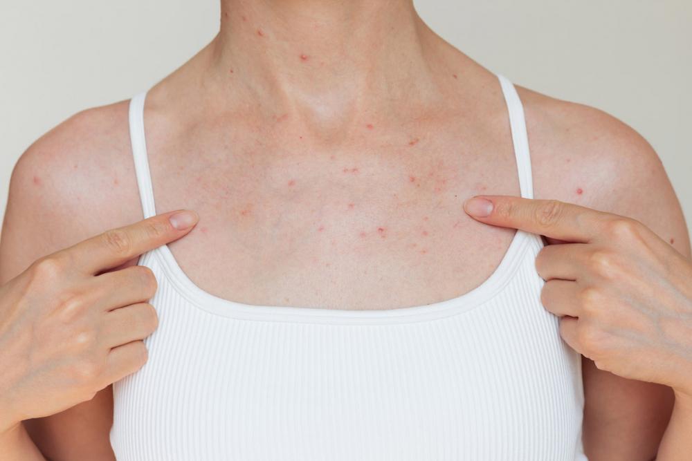 Сыпь на груди у женщин 