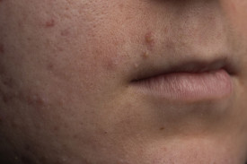 Мелкие пузырьки на лице