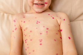 Сыпь на груди у ребенка