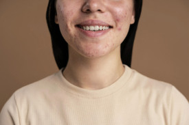 Пятна на лице от прыщей