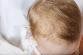 Прыщи на голове у ребенка