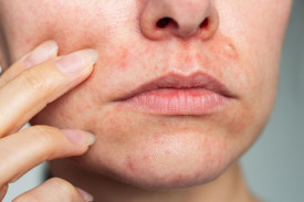Раздражение на коже лица