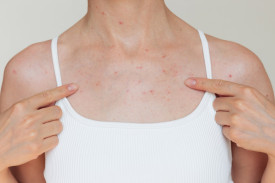 Сыпь на груди у женщин